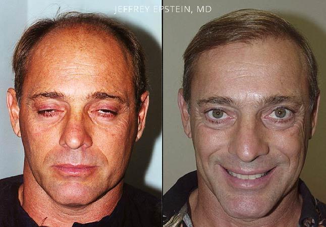 Hair Transplants for Men Before and after in Miami, FL, Paciente 39258