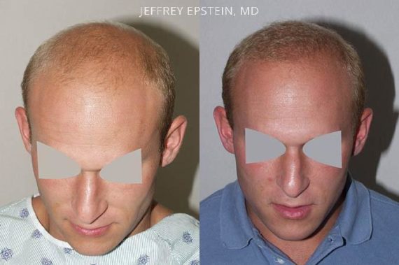 Trasplante de Pelo en Hombres Before and after in Miami, FL, Paciente 80062