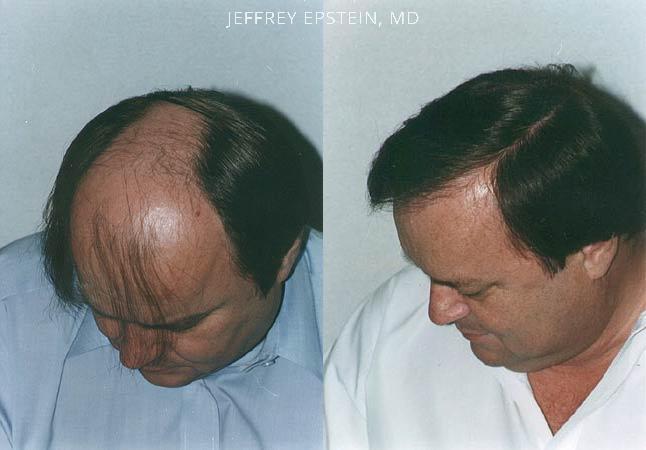 Hair Transplants for Men Before and after in Miami, FL, Paciente 39266