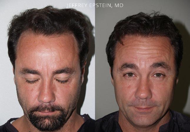 Hair Transplants for Men Before and after in Miami, FL, Paciente 39269
