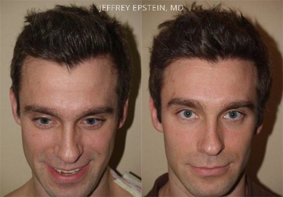 Trasplante de Pelo en Hombres Before and after in Miami, FL, Paciente 79991