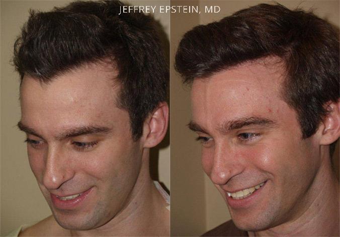 Hair Transplants for Men Before and after in Miami, FL, Paciente 39272