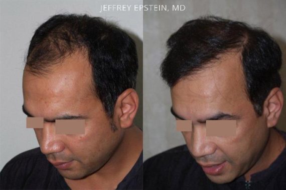 Trasplante de Pelo en Hombres Before and after in Miami, FL, Paciente 79960