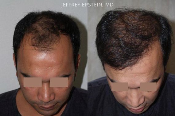 Trasplante de Pelo en Hombres Before and after in Miami, FL, Paciente 79960