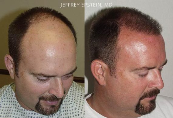 Trasplante de Pelo en Hombres Before and after in Miami, FL, Paciente 79939