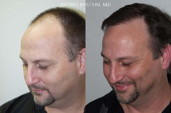 Trasplante de Pelo en Hombres Before and after in Miami, FL, Paciente 79910