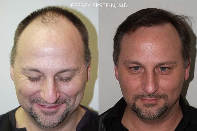 Hair Transplants for Men Before and after in Miami, FL, Paciente 39292