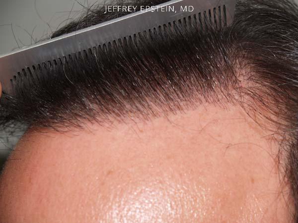 Hair Transplants for Men Before and after in Miami, FL, Paciente 39298