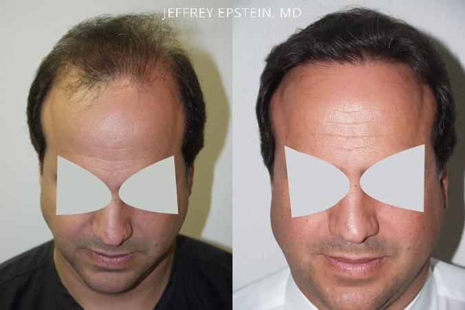 Trasplante de Pelo en Hombres Antes y después en Miami, FL, Paciente 79881