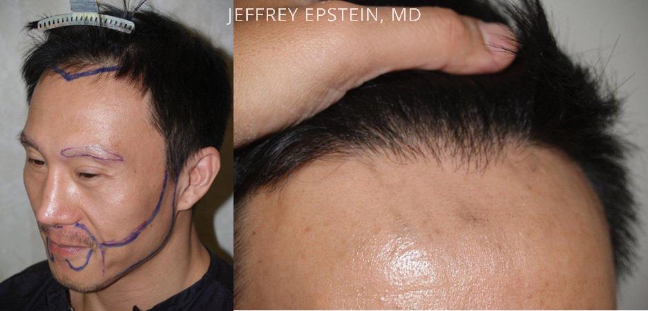 Hair Transplants for Men Before and after in Miami, FL, Paciente 39304
