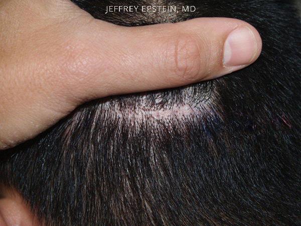 Hair Transplants for Men Before and after in Miami, FL, Paciente 39304