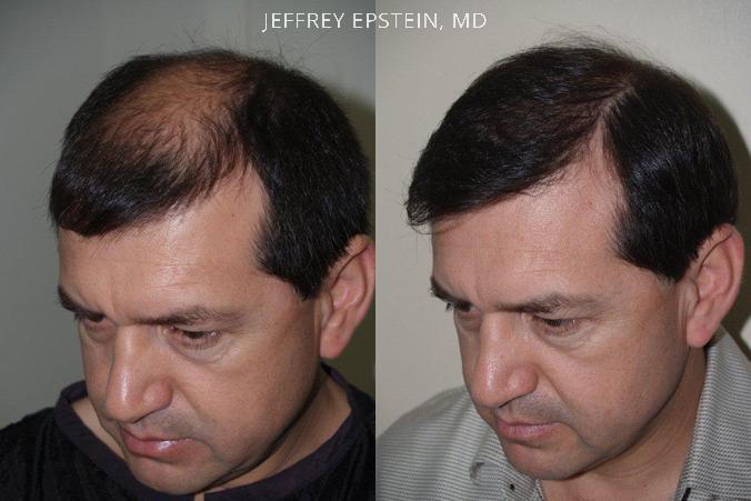 Hair Transplants for Men Before and after in Miami, FL, Paciente 39324
