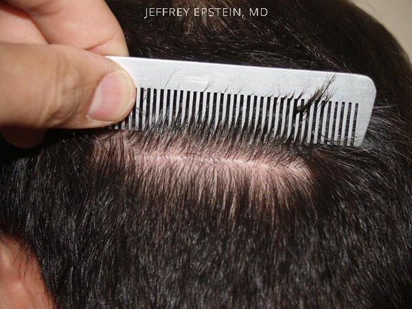 Hair Transplants for Men Before and after in Miami, FL, Paciente 39324