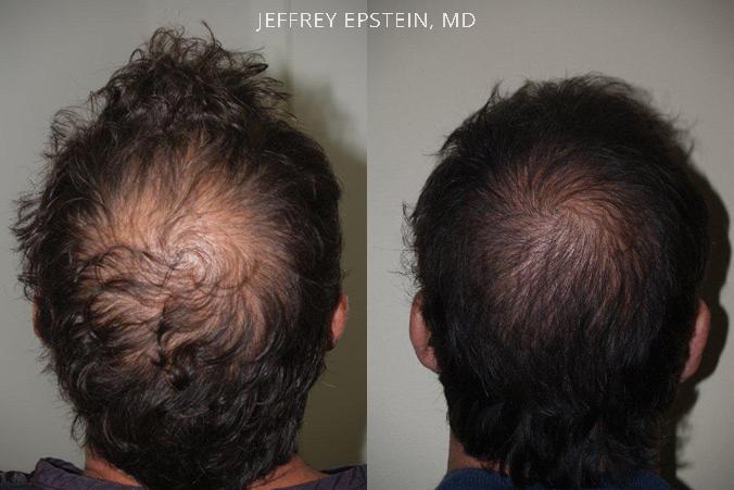 Hair Transplants for Men Before and after in Miami, FL, Paciente 39338
