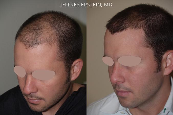 Hair Transplants for Men Before and after in Miami, FL, Paciente 39341