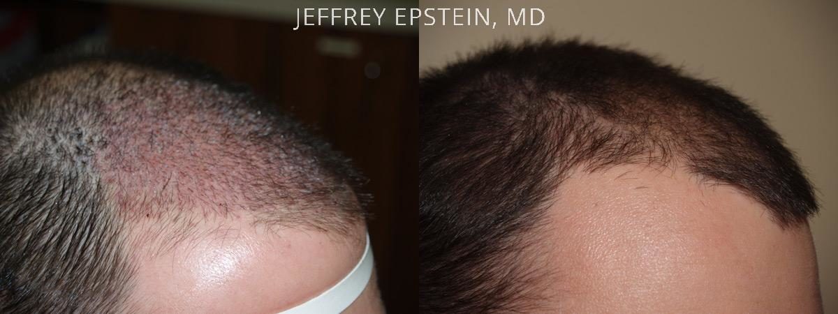 Hair Transplants for Men Before and after in Miami, FL, Paciente 39341
