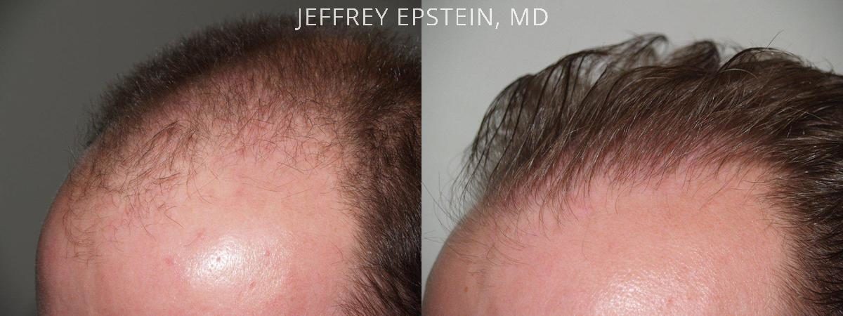 Hair Transplants for Men Before and after in Miami, FL, Paciente 39349