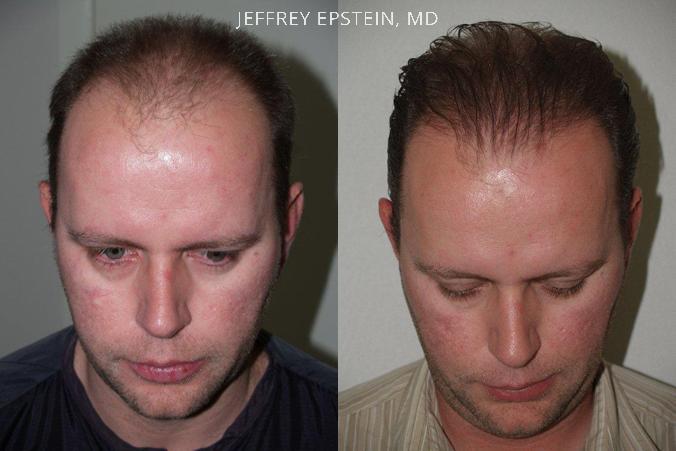 Hair Transplants for Men Before and after in Miami, FL, Paciente 39349