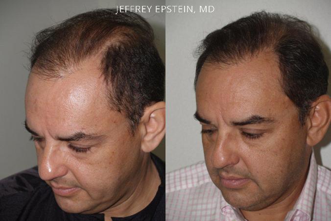 Hair Transplants for Men Before and after in Miami, FL, Paciente 39358