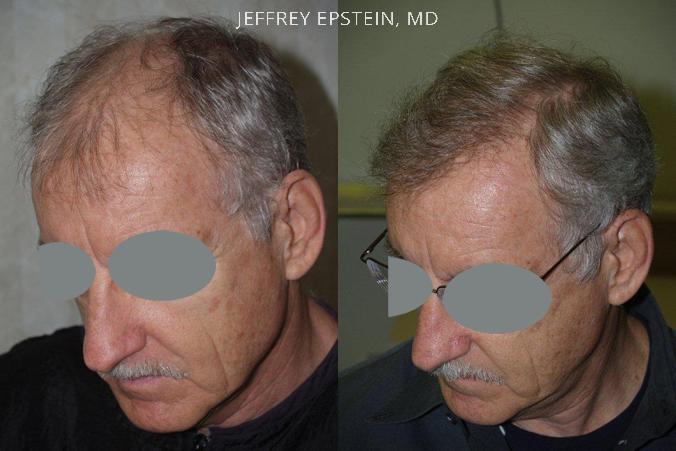 Hair Transplants for Men Before and after in Miami, FL, Paciente 39363