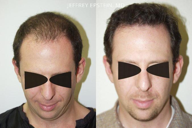 Hair Transplants for Men Before and after in Miami, FL, Paciente 39375
