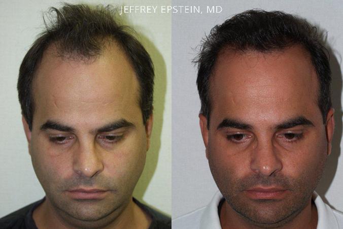 Hair Transplants for Men Before and after in Miami, FL, Paciente 39383