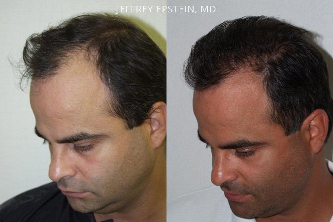 Hair Transplants for Men Before and after in Miami, FL, Paciente 39383