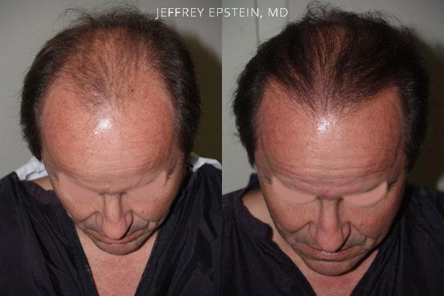 Hair Transplants for Men Before and after in Miami, FL, Paciente 39392