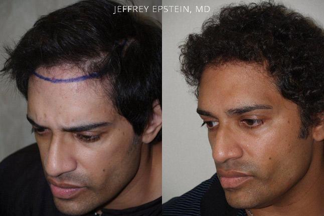 Hair Transplants for Men Before and after in Miami, FL, Paciente 39408