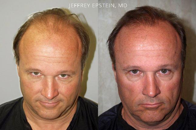Hair Transplants for Men Before and after in Miami, FL, Paciente 39415