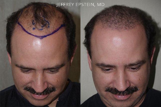 Hair Transplants for Men Before and after in Miami, FL, Paciente 39420
