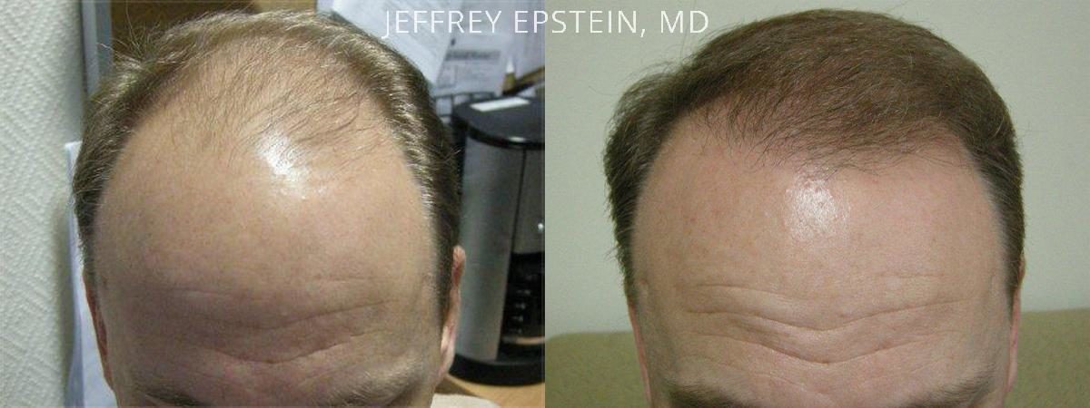 Hair Transplants for Men Before and after in Miami, FL, Paciente 39423
