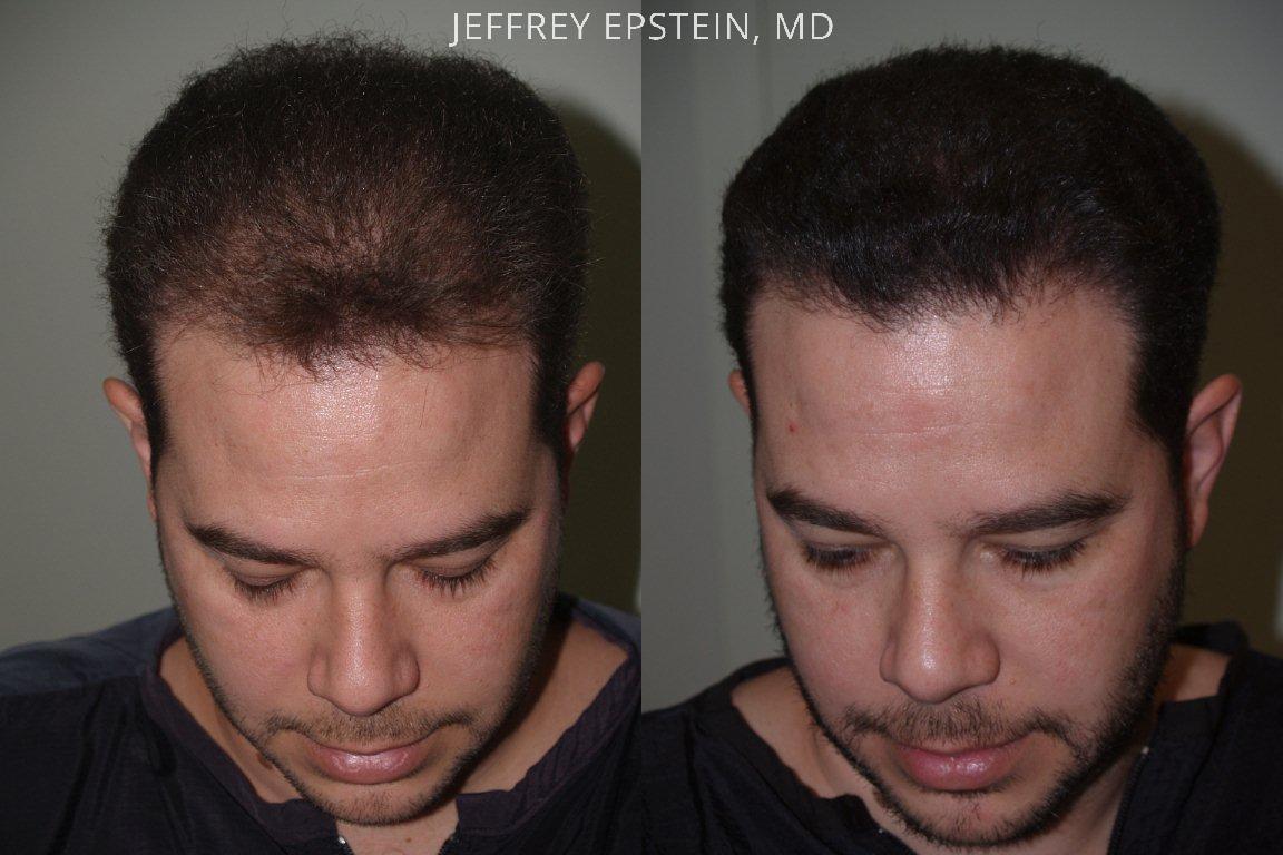 Hair Transplants for Men photos | Miami, FL | Patient39426