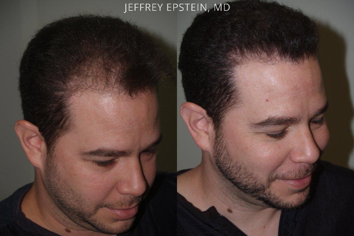 Hair Transplants for Men Before and after in Miami, FL, Paciente 39426