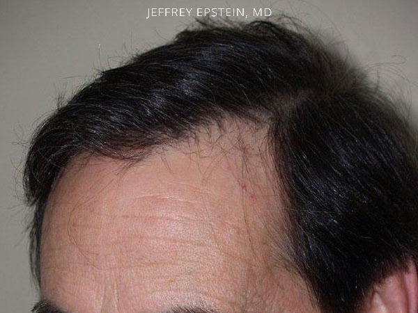 Hair Transplants for Men Before and after in Miami, FL, Paciente 39439