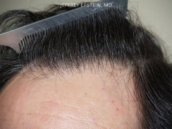 Hair Transplants for Men Before and after in Miami, FL, Paciente 39439