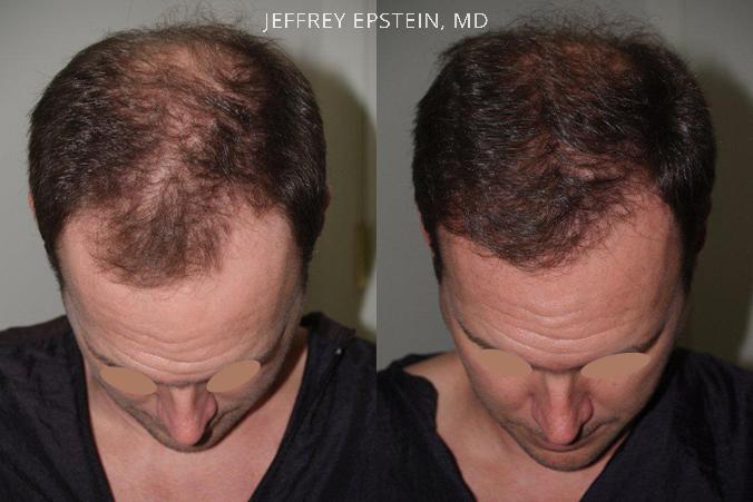 Hair Transplants for Men Before and after in Miami, FL, Paciente 39449