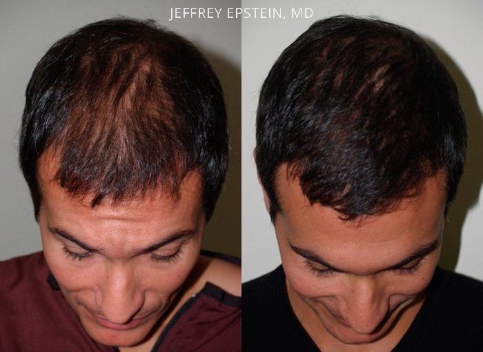 Hair Transplants for Men Before and after in Miami, FL, Paciente 39457