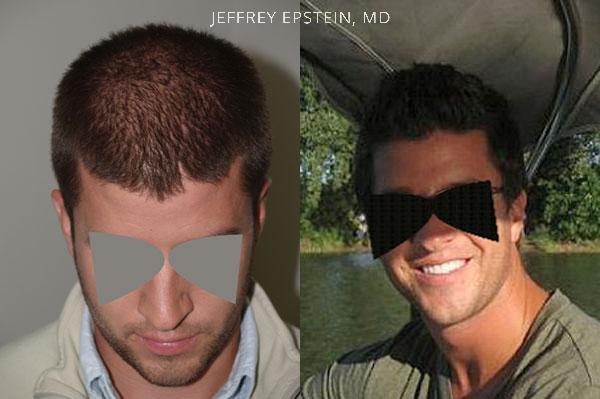 Hair Transplants for Men Before and after in Miami, FL, Paciente 39474