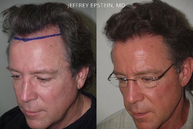 Hair Transplants for Men Before and after in Miami, FL, Paciente 39482