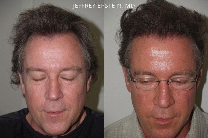 Hair Transplants for Men Before and after in Miami, FL, Paciente 39482