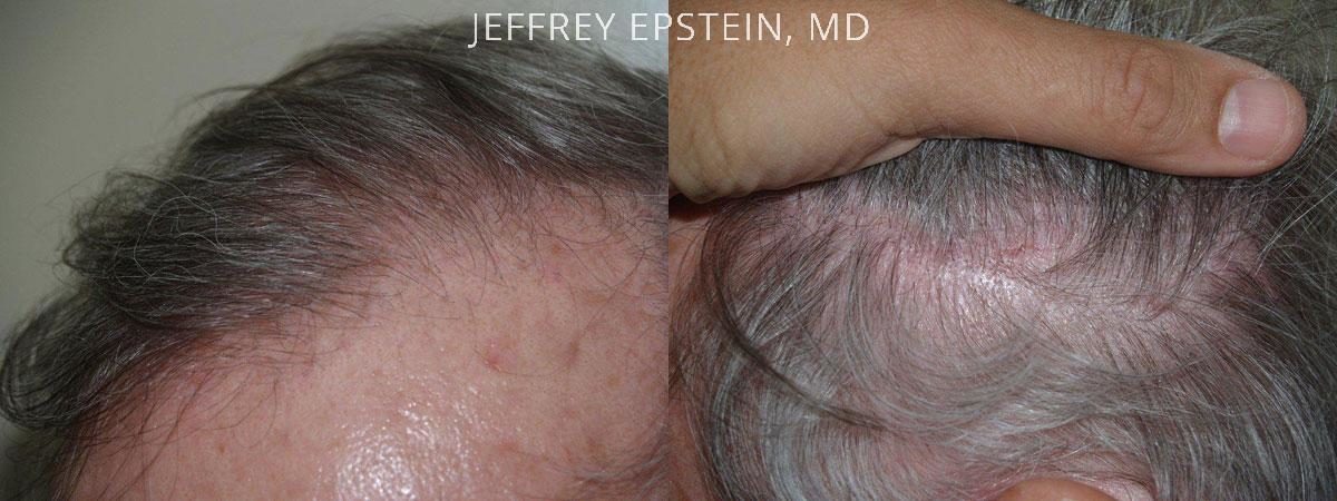 Hair Transplants for Men Before and after in Miami, FL, Paciente 39489