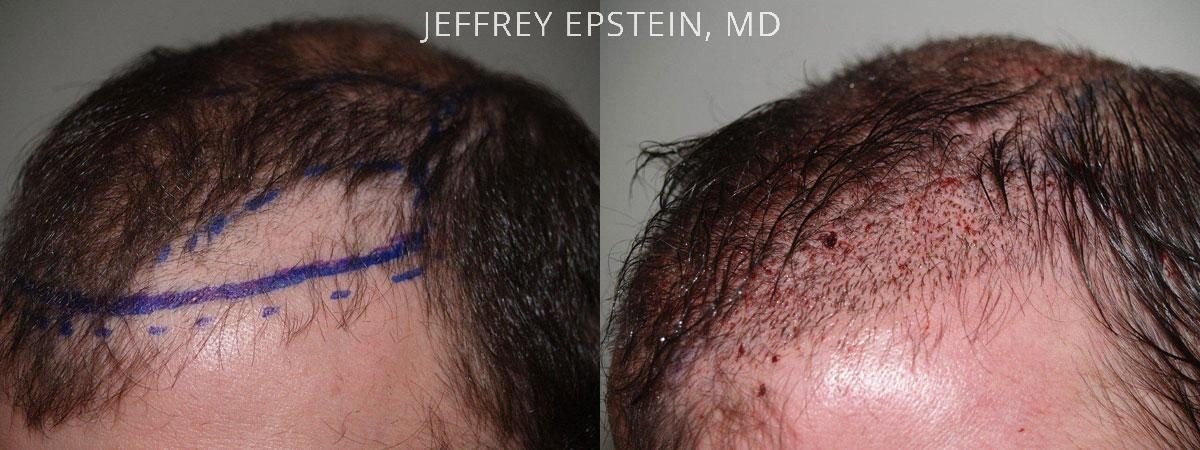 Hair Transplants for Men Before and after in Miami, FL, Paciente 39497