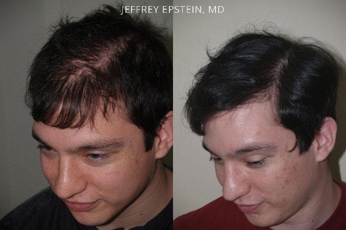 Hair Transplants for Men Before and after in Miami, FL, Paciente 39501