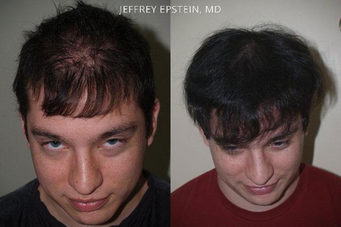 Hair Transplants for Men Before and after in Miami, FL, Paciente 39501