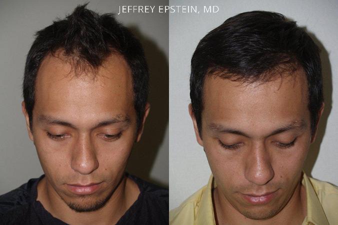 Hair Transplants for Men Before and after in Miami, FL, Paciente 39507