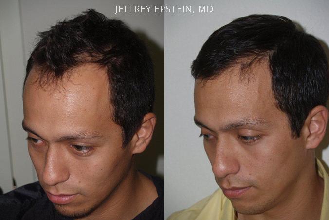 Hair Transplants for Men Before and after in Miami, FL, Paciente 39507