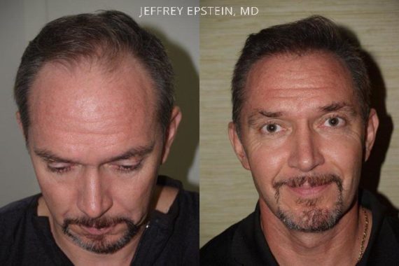 Trasplante de Pelo en Hombres Before and after in Miami, FL, Paciente 78833