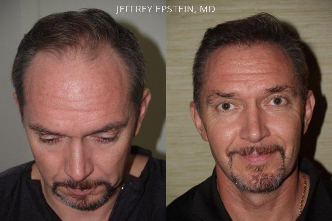 Hair Transplants for Men Before and after in Miami, FL, Paciente 39516