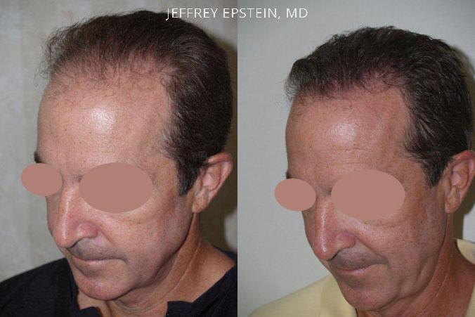 Hair Transplants for Men Before and after in Miami, FL, Paciente 39522